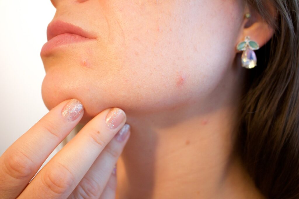 Cutting processed sugar may help acne and skin inflammation